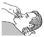 Tilt the personâ€™s head back and provide support under the neck with your hand - Illustration