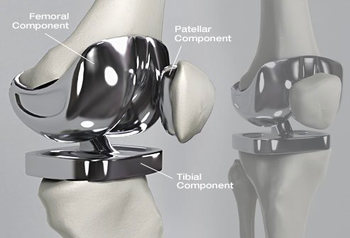 During knee replacement surgery, the surgeon takes damaged cartilage and bone out of the knee joint and replaces them with a manmade joint.