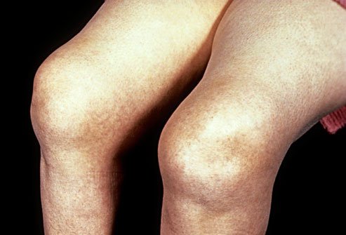 Rheumatoid arthritis is a chronic illness in which the body's immune system mistakenly attacks the joints, causing pain and swelling.