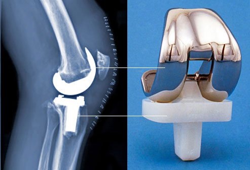 Knee replacement usually takes 1 to 2 hours.