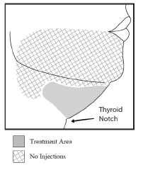 Avoid the Marginal Mandibular Nerve Area - Illustration