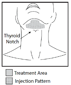 Treatment Area and Injection Pattern - Illustration