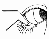 Place the tip of the applicator containing LACRISERT into the pocket. - Illustration