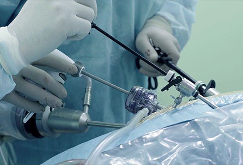 Laparoscopic inguinal hernia surgery involves repairing a weakness or perforation in the abdominal muscle wall (hernia).