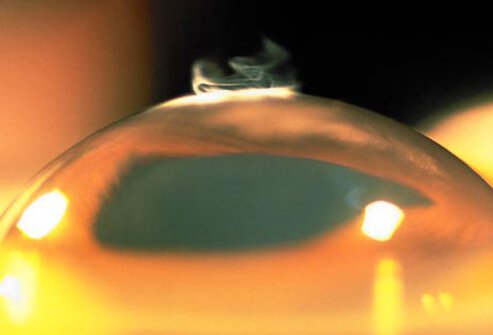 Excimer laser refractive surgery, commonly known as laser vision correction, has been around for the past 20 years. 