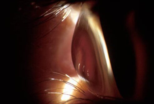 Conditions such as collagen vascular diseases, lupus, rheumatoid arthritis, and HIV-associated diseases may influence proper wound healing, which is necessary to achieve a good result.