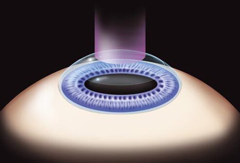 Photo-refractive keratectomy (PRK), involves the use of the excimer laser on the cornea without making a LASIK flap.