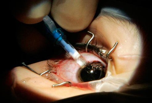 There are some patients whose myopia (nearsightedness) is so great, that laser refractive surgery cannot correct their vision without significantly thinning the cornea.