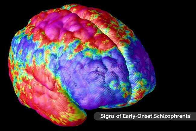 Handedness may play a role in mental conditions like schizophrenia. 
