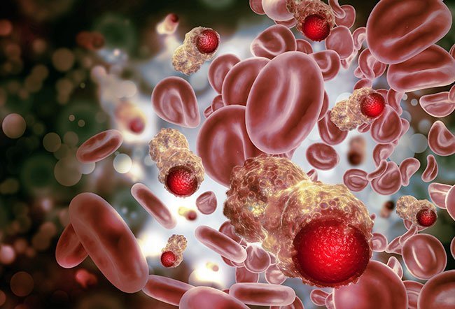 Leiomyosarcoma is a rare type of soft tissue cancer that occurs in the smooth lining of the organs anywhere in the body.