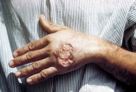 Picture of a skin ulcer due to leishmaniasis, hand of Central American adult.