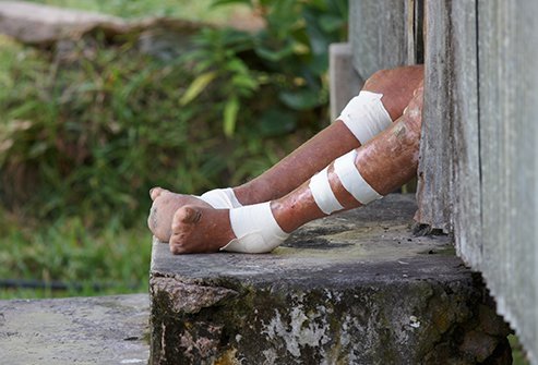 The progression of leprosy includes skin ulcers and lesions accompanied by loss of sensation and eventual loss of digits and other extremities.