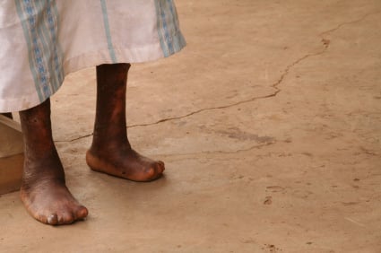 Picture of a person with leprosy (Hansen's disease)