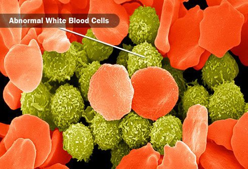 Leukemia is cancer of the blood cells.
