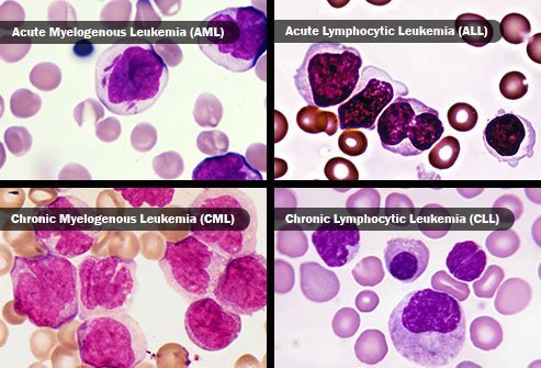 Acute myelogenous leukemia (AML) is the most common acute type in adults. 