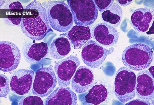 Unlike other cancers, stages of leukemia don't describe how far the cancer has spread.