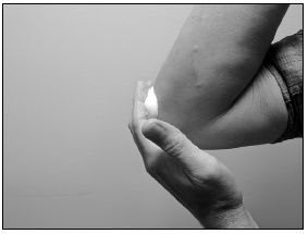 Apply a thin layer of LEXETTE to the affected skin area - Illustration Apply a thin layer of LEXETTE to the affected skin area - Illustration