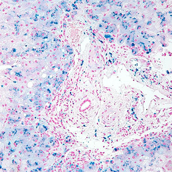 High magnification micrograph of hemosiderosis. Liver biopsy.