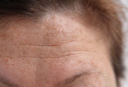 Retinoids combat fine lines and wrinkles.