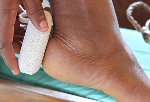 Use a pumice stone to remove dead skin from the heels and balls of your feet. 