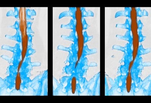 Conditions that can lead to chronic low back pain include spinal stenosis, spondylitis, and fibromyalgia.