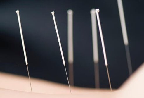 Acupuncture can be moderately effective for chronic low back pain.