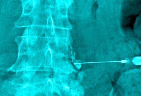X-ray of hydrocortisone injection in the spine.