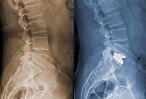 Back surgery is often a last resort when all other treatment options have been tried.