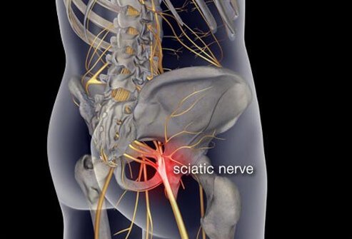 Back pain that occurs after excessive exercise or heavy lifting is frequently a strain injury.