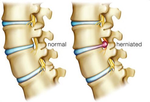 These discs can degenerate with aging and are prone to injury as a result.
