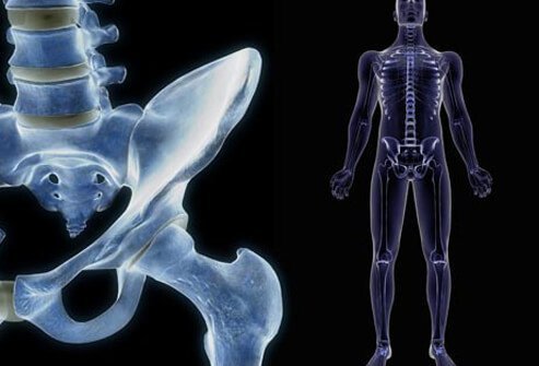 Although osteoporosis (brittle bone disease) is usually thought of as occurring mainly in women, the disease in men is commonly caused by low testosterone.