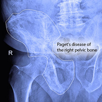 X-ray of Paget's disease of the right coxa.