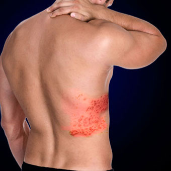 A male experiences back pain due to the shingles rash.