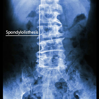 X-ray of patient with spondylolisthesis of lower back.