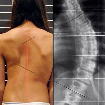 A female with scoliosis shows curvature of the spine.