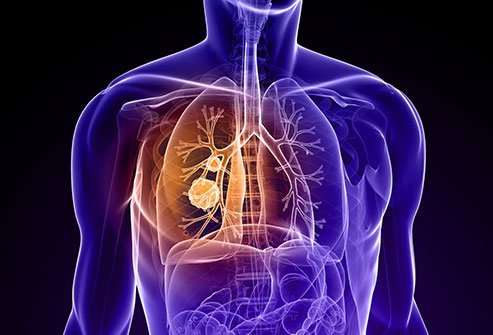 Signs of Lung Cancer