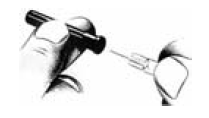 Activate the LuproLoc® safety device - Illustration