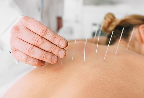 Acupuncture involves the use of small, thin needles that pierce the skin at specific acupuncture points. Acupuncture for pain relief is an alternative to over-the-counter medicines and addictive opioids. Acupuncture involves the use of small, thin needles that pierce the skin at specific acupuncture points. Acupuncture for pain relief is an alternative to over-the-counter medicines and addictive opioids.