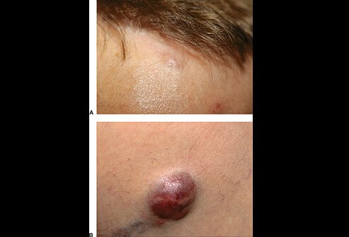 Picture of Merkel Cell Carcinoma