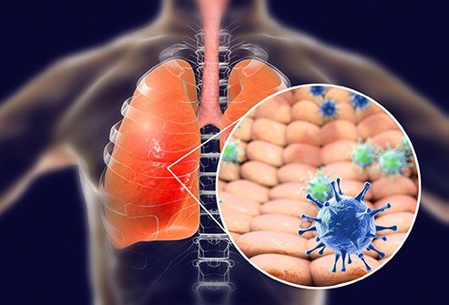 MERS-CoV is a type of coronavirus that spreads through respiratory secretions.