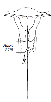 Median Menstrual Blood Loss (MBL) by Time
and Treatment - Illustration