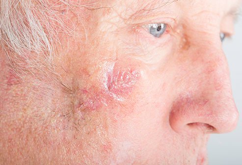 Picture of Mohs surgery scar, after Mohs surgery care
