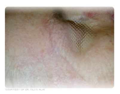 Healed post-op site