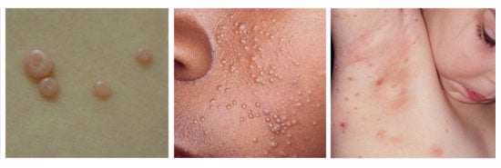 Pictures of molluscum contagiosum