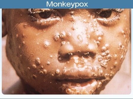 Picture of the pustules/papules of characteristic monkeypox rash Picture of the pustules/papules of characteristic monkeypox rash