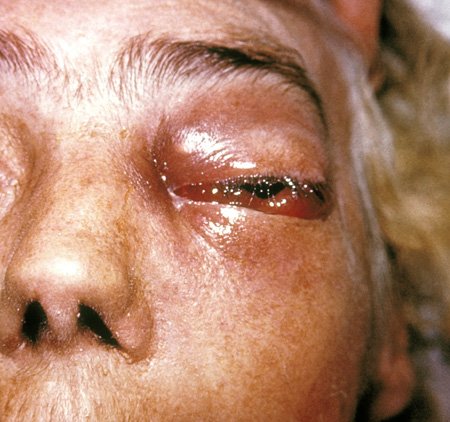 Picture of periorbital fungal infection known as zygomycosis, mucormycosis, or 
phycomycosis