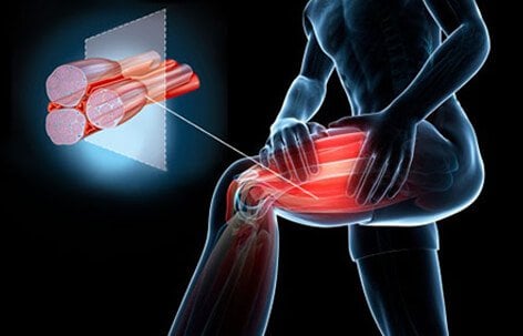 Muscle cramps can range from being a mild nuisance to incapacitating and extremely painful.