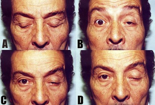 Most individuals with myasthenia can lead normal or nearly normal lives