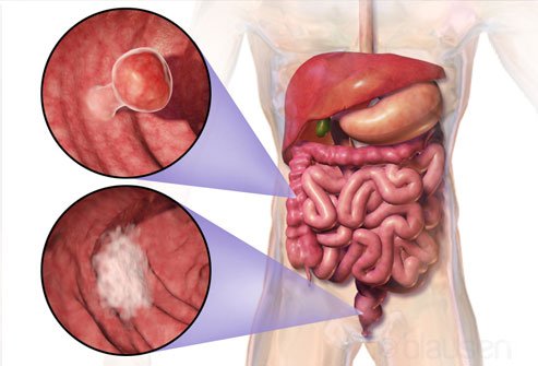 Chronic constipation does not lead to colon cancer. 