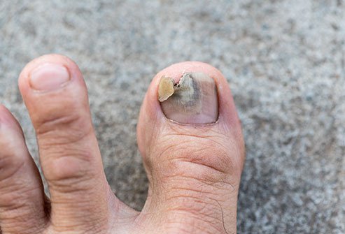 An injury to the nail bed may require a trip to the ER depending on the extent of the injury. An injury to the nail bed may require a trip to the ER depending on the extent of the injury.